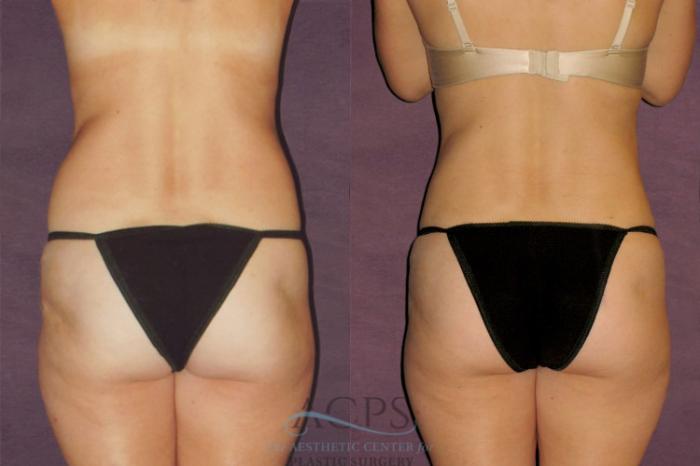 Before & After Liposuction Case 135 Rear View: View in Houston, TX