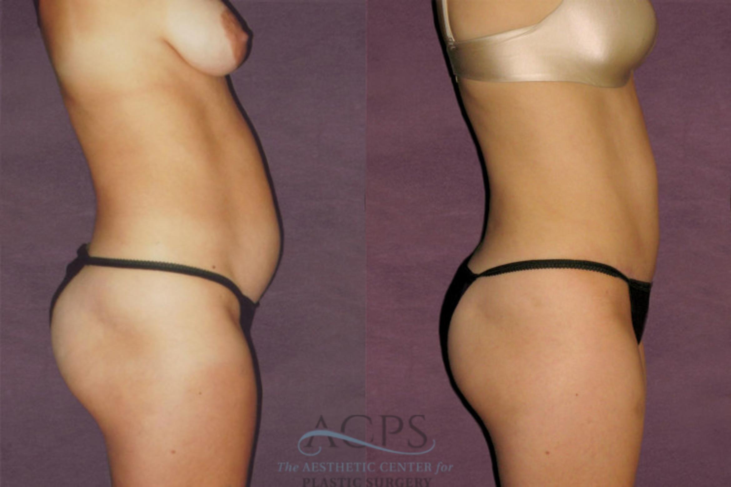 Before & After Liposuction Case 135 Side Right View: View in Houston, TX