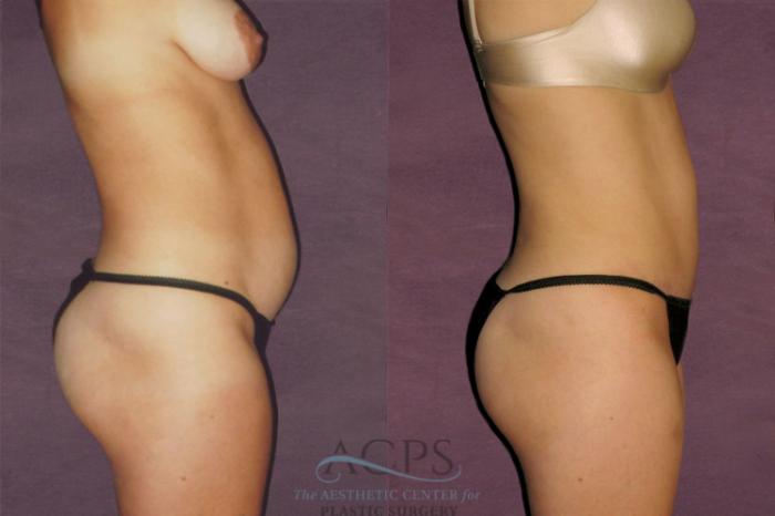 Before & After Liposuction Case 135 Side Right View: View in Houston, TX