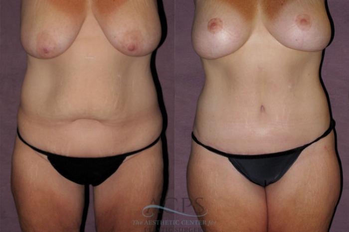 Before & After Tummy Tuck Case 136 Front View: View in Houston, TX