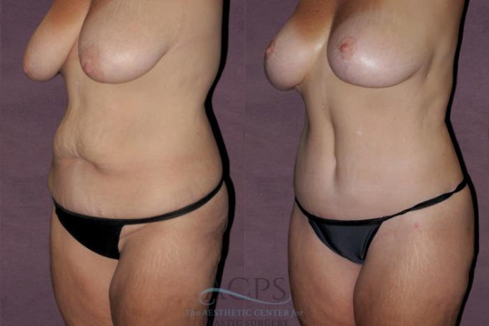 Before & After Tummy Tuck Case 136 Oblique Left View: View in Houston, TX
