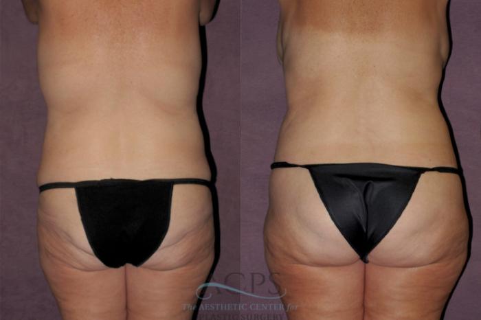 Before & After Tummy Tuck Case 136 Rear View: View in Houston, TX