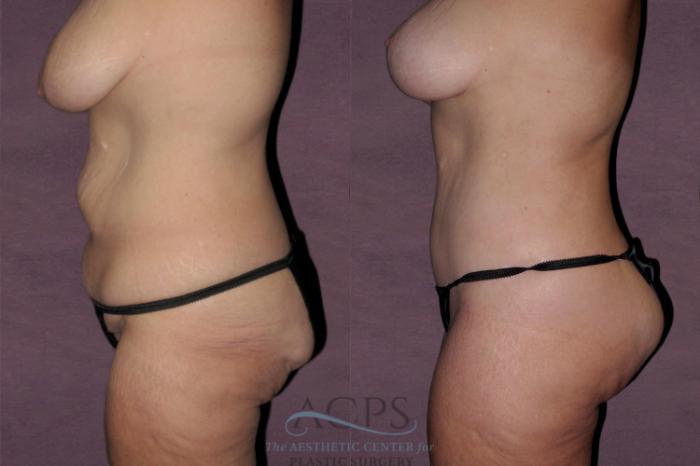 Before & After Tummy Tuck Case 136 Side Left View: View in Houston, TX