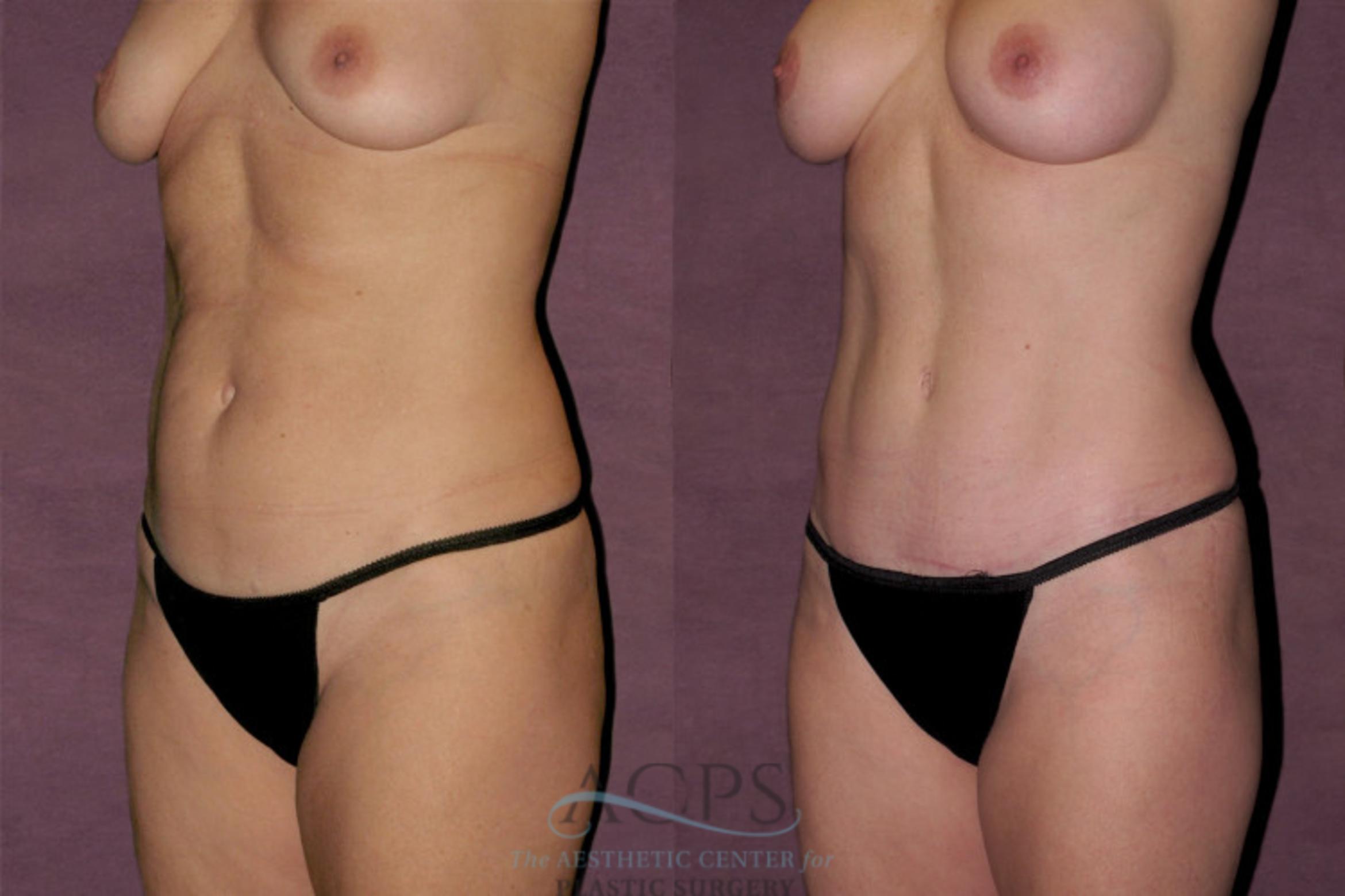 Before & After Mommy Makeover Case 137 Oblique Left View: View in Houston, TX