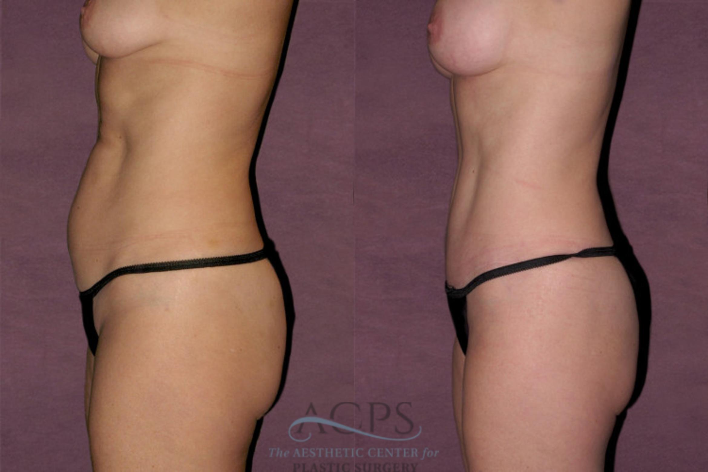 Before & After Mommy Makeover Case 137 Side Left View: View in Houston, TX