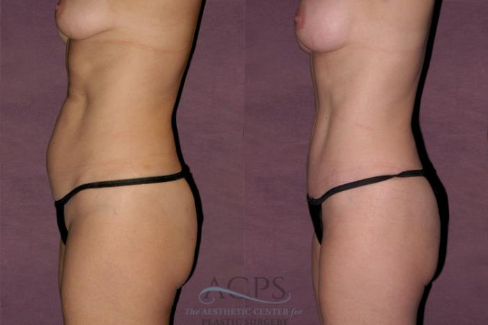 Before & After Mommy Makeover Case 137 Side Left View: View in Houston, TX