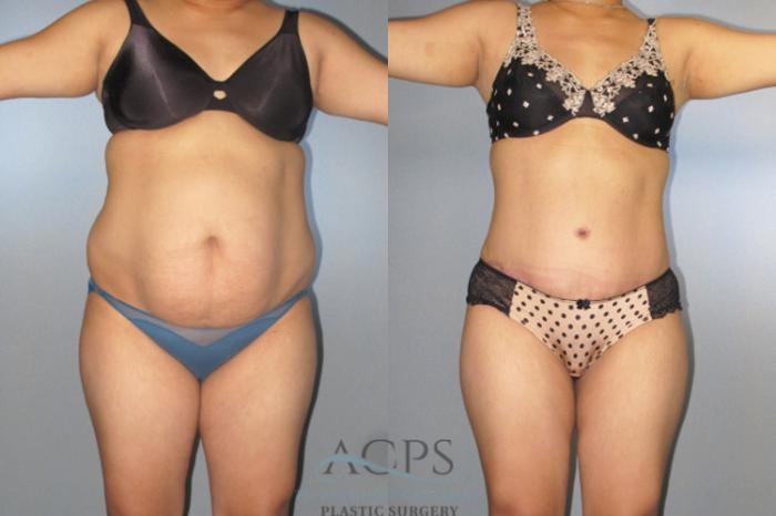 Before & After Tummy Tuck Case 138 Front View: View in Houston, TX