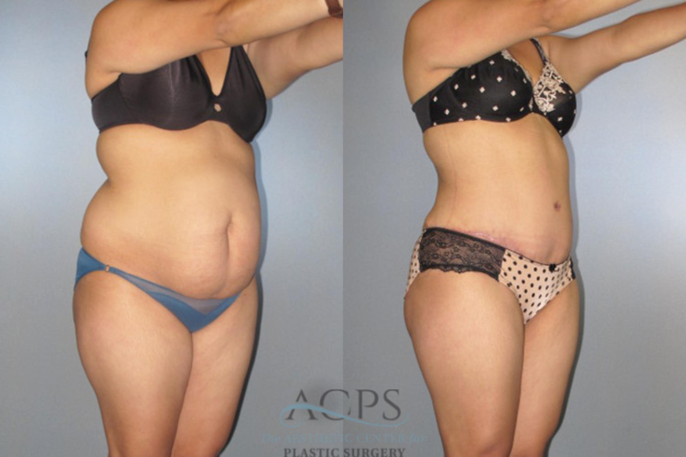 Before & After Tummy Tuck Case 138 Oblique View: View in Houston, TX
