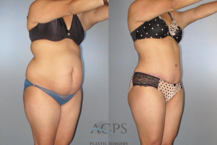 Before & After Tummy Tuck Case 138 Oblique View: View in Houston, TX