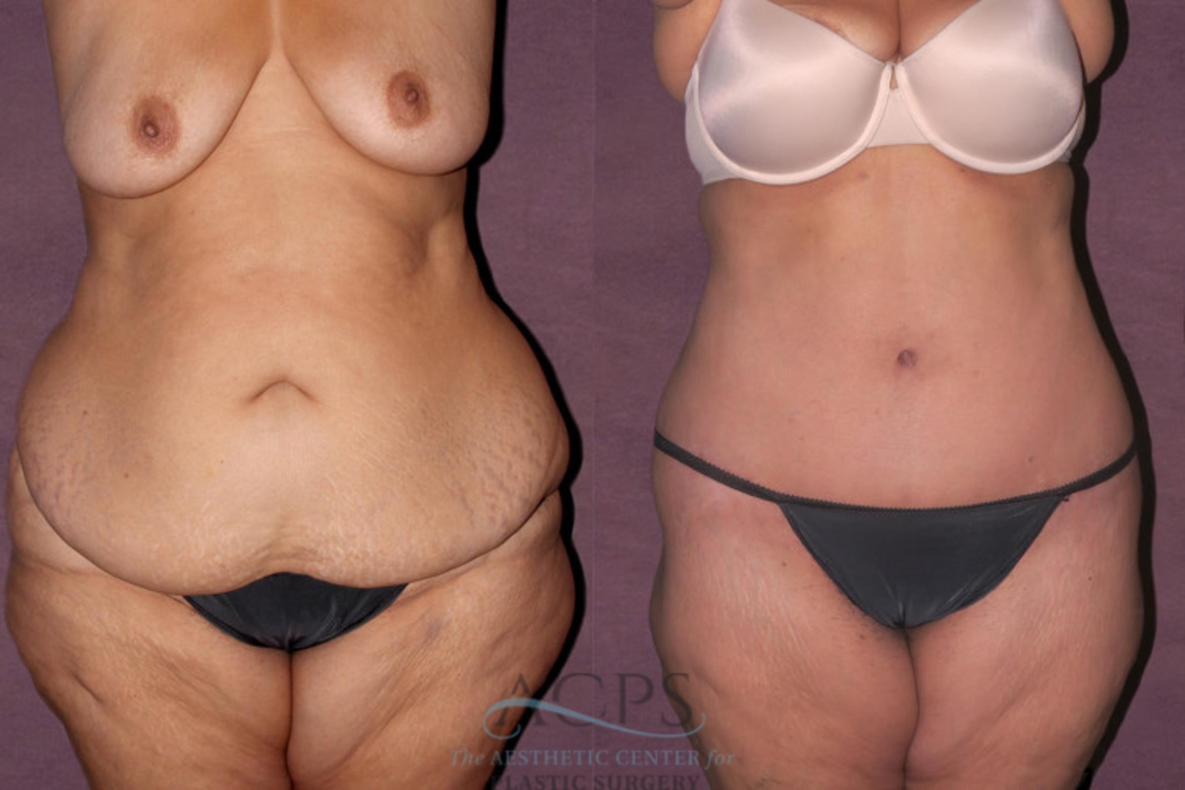 Before & After Liposuction Case 139 Front View: View in Houston, TX