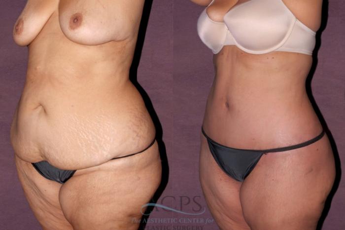 Before & After Liposuction Case 139 Oblique Left View: View in Houston, TX