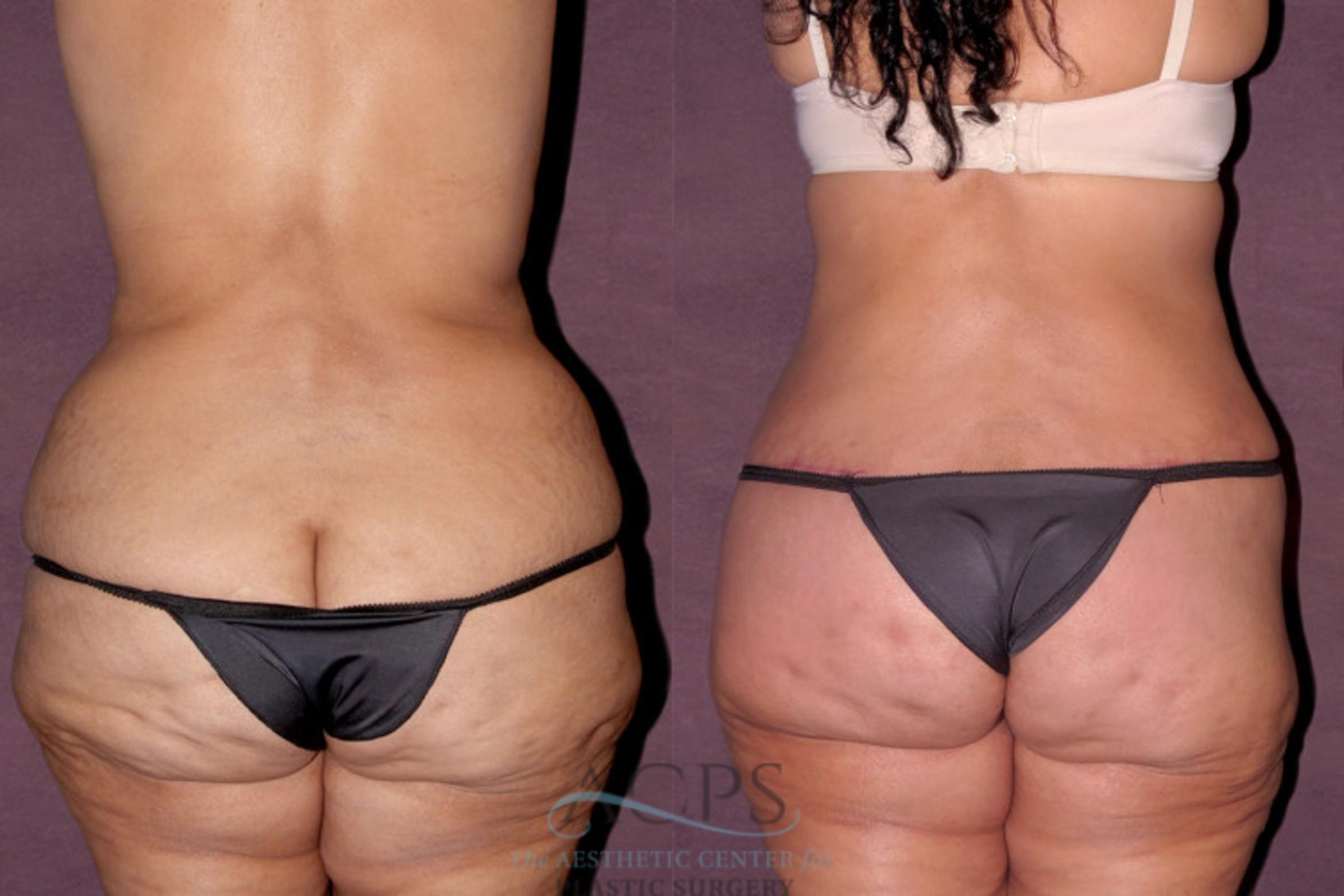 Before & After Liposuction Case 139 Rear View: View in Houston, TX