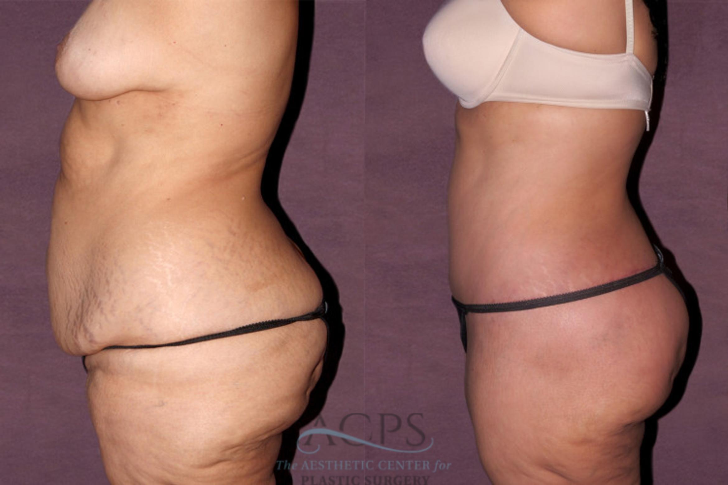 Before & After Liposuction Case 139 Side Left View: View in Houston, TX