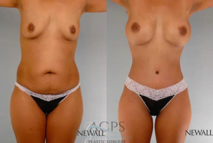 Before & After Tummy Tuck Case 14 Front View: View in Houston, TX