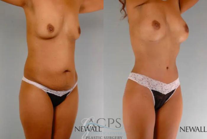 Before & After Tummy Tuck Case 14 Oblique View: View in Houston, TX