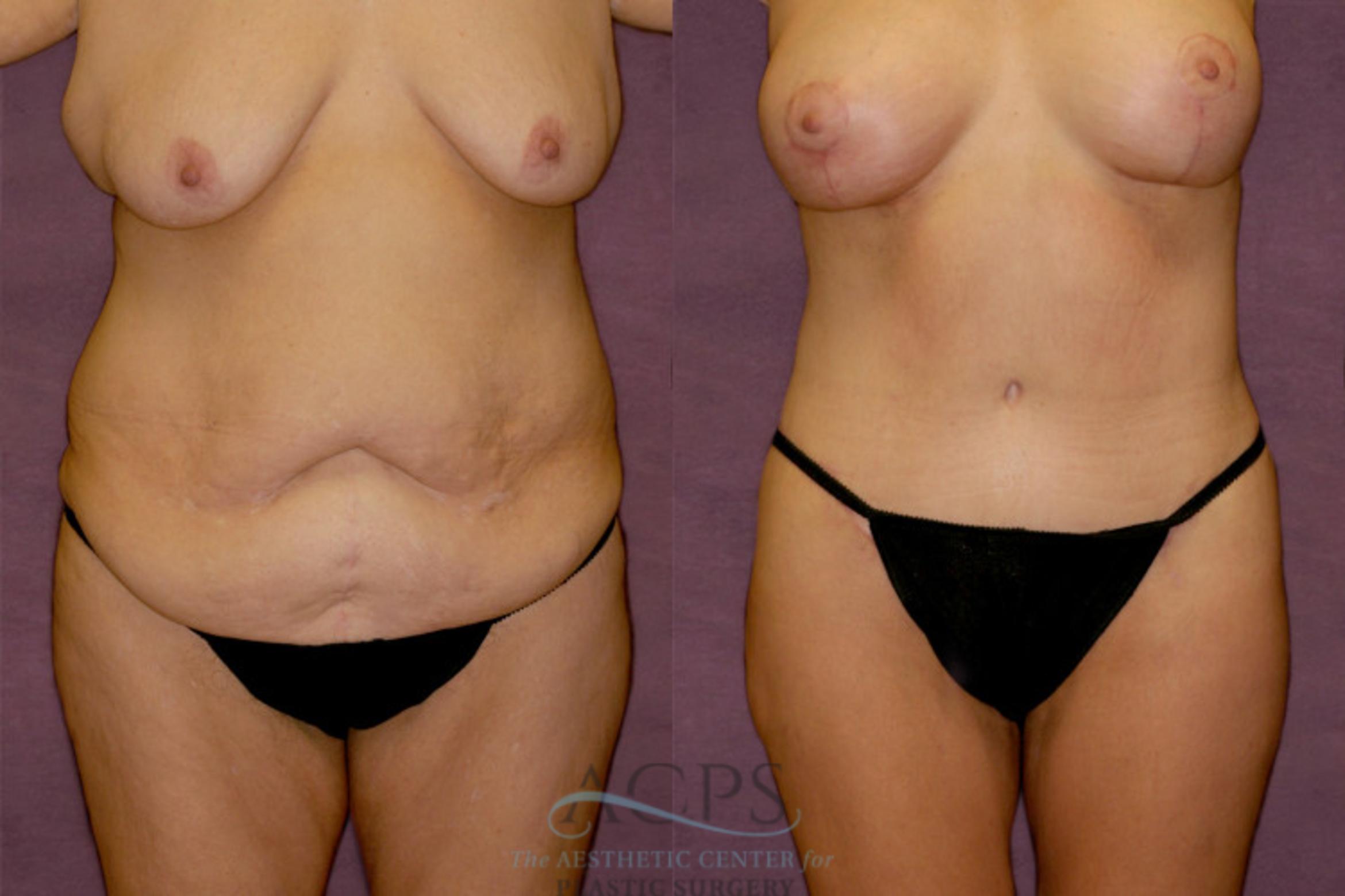 Before & After Tummy Tuck Case 140 Front View: View in Houston, TX