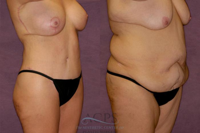 Before & After Tummy Tuck Case 140 Oblique Right View: View in Houston, TX