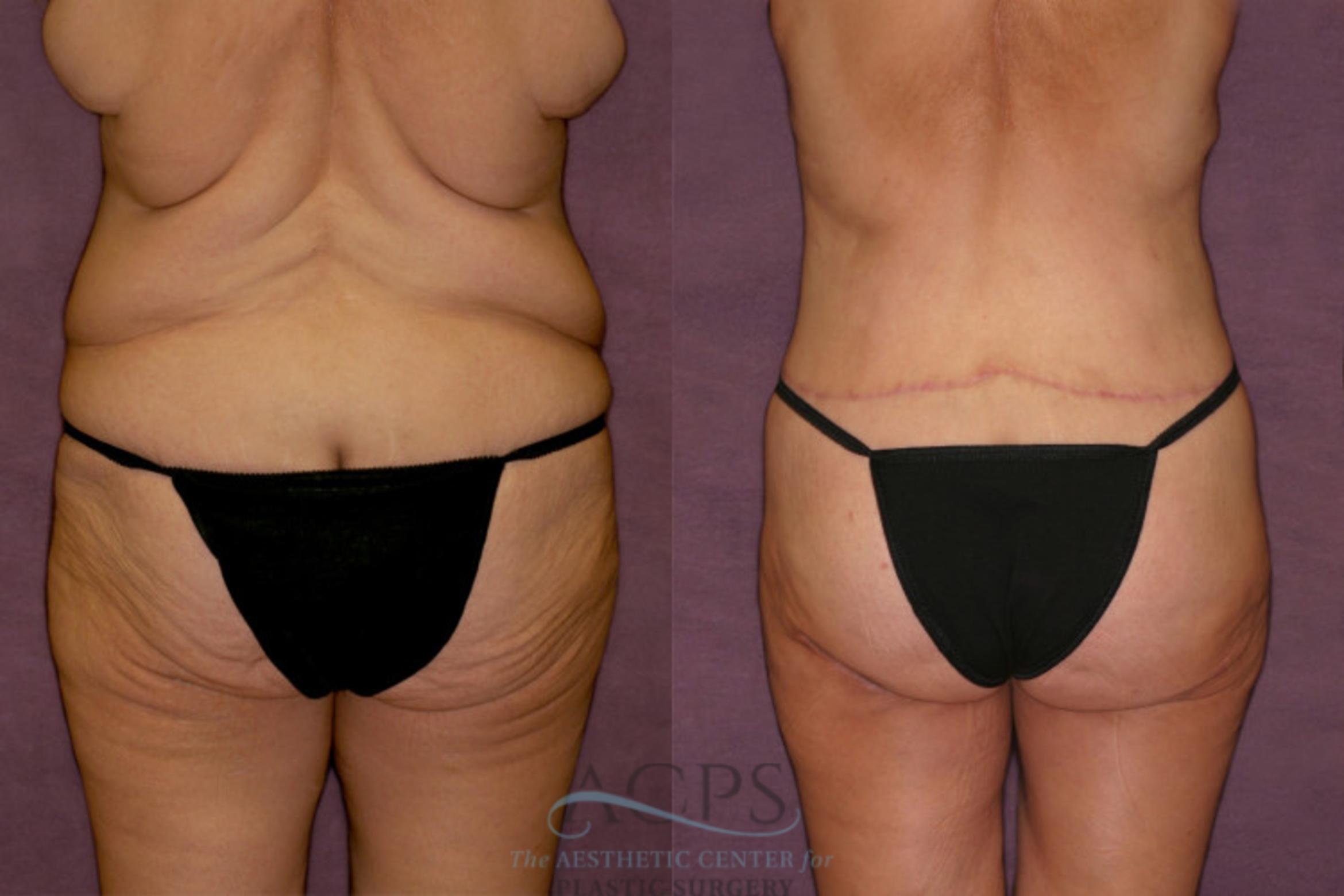 Before & After Tummy Tuck Case 140 Rear View: View in Houston, TX