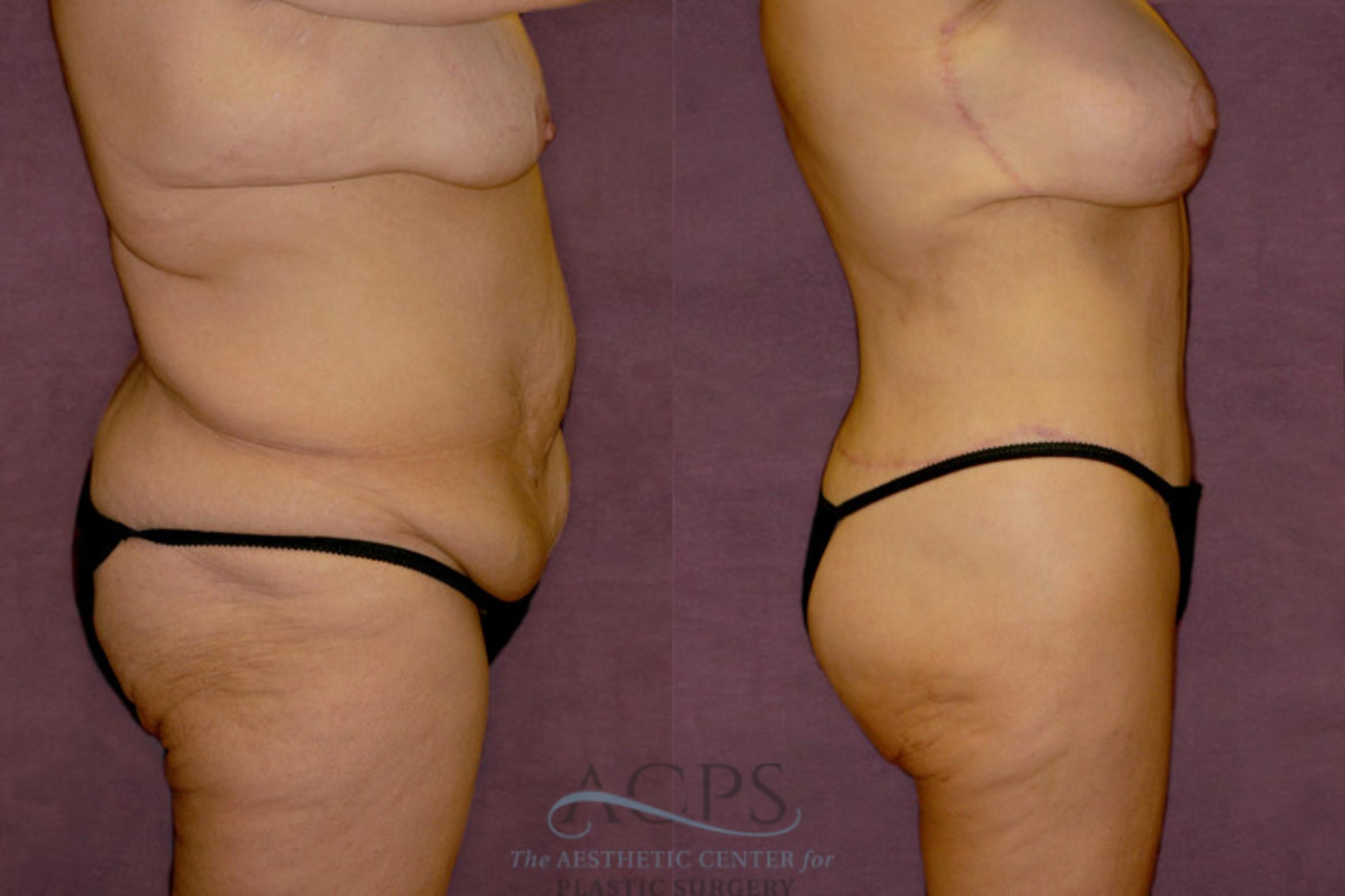 Before & After Tummy Tuck Case 140 Side Right View: View in Houston, TX
