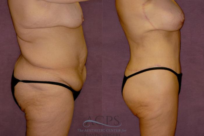 Before & After Tummy Tuck Case 140 Side Right View: View in Houston, TX