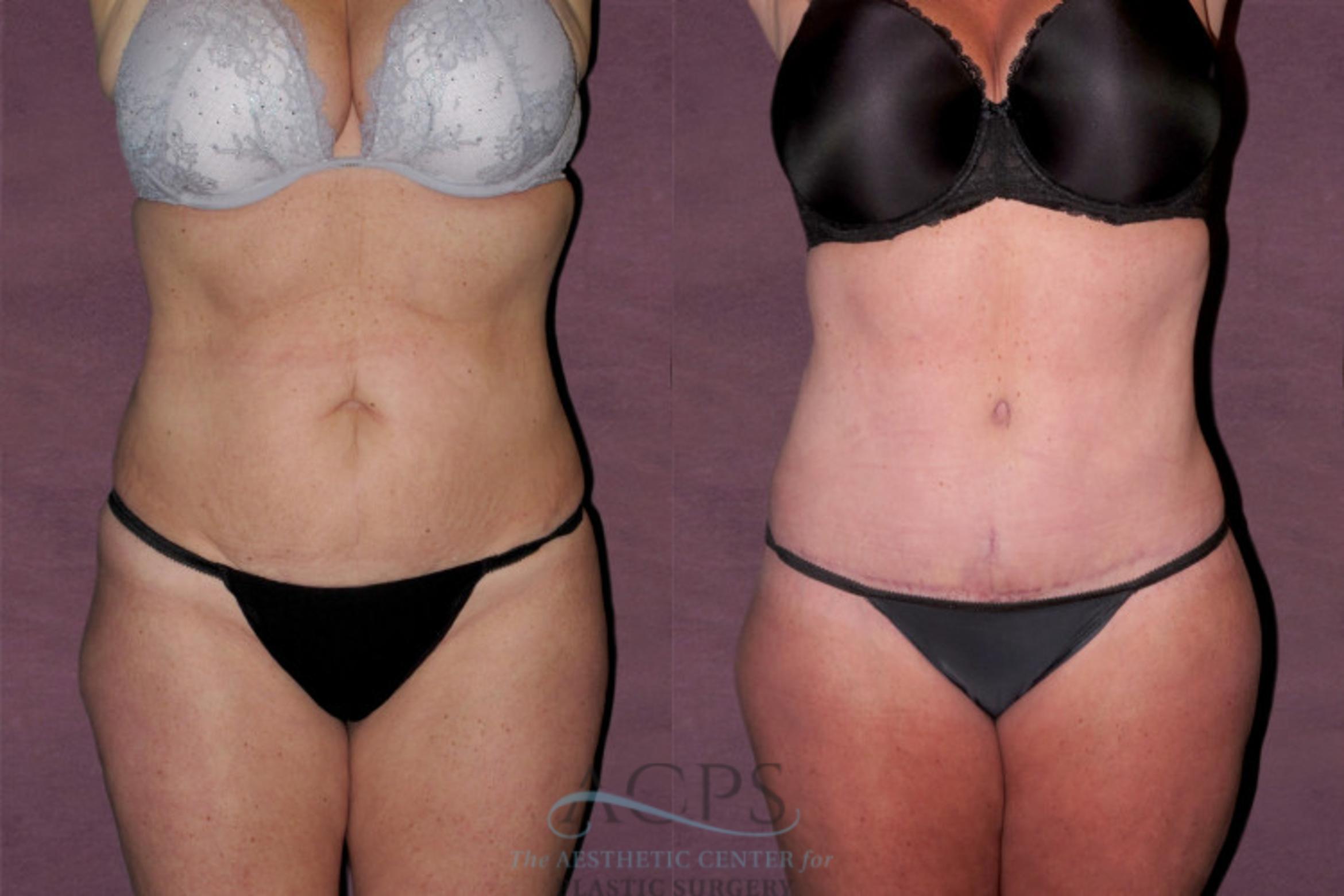 Before & After Tummy Tuck Case 141 Front View: View in Houston, TX