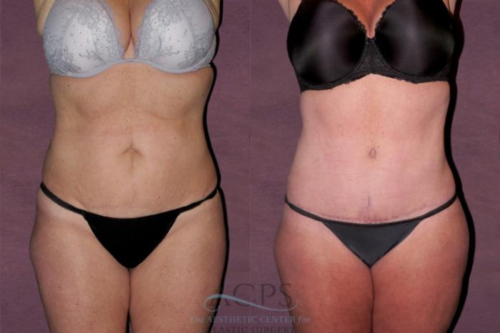 Before & After Tummy Tuck Case 141 Front View: View in Houston, TX