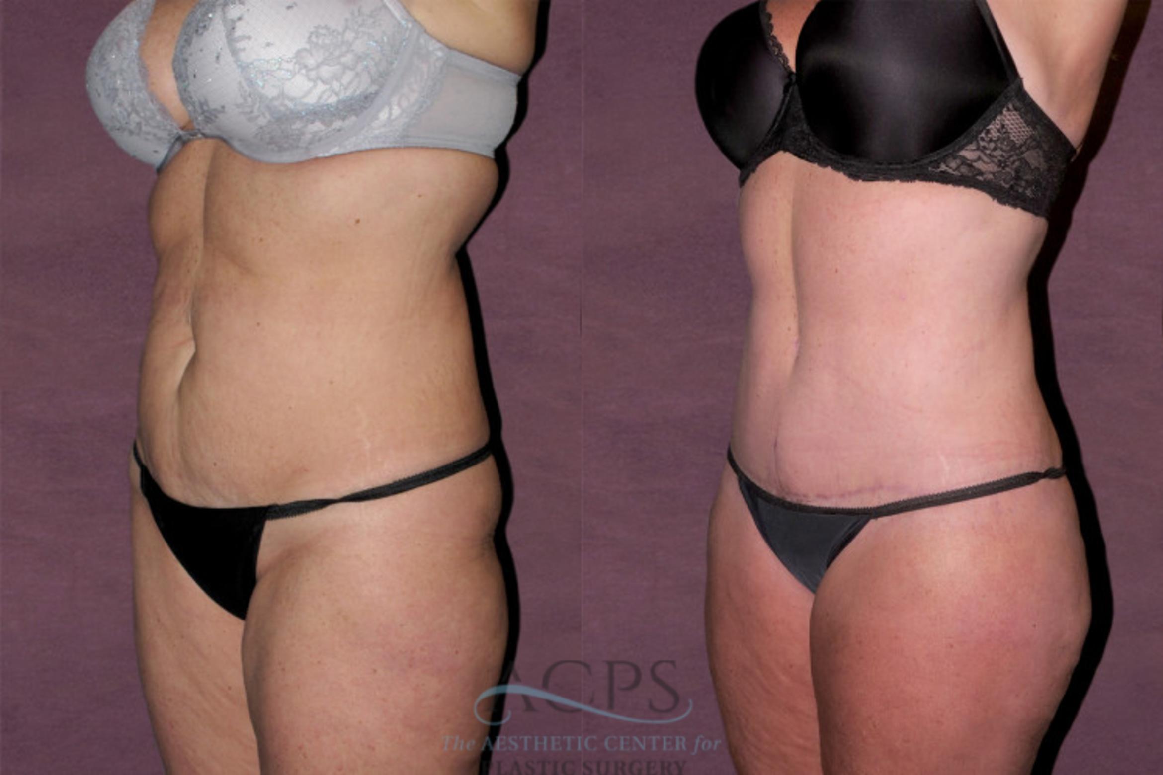 Before & After Tummy Tuck Case 141 Oblique Left View: View in Houston, TX
