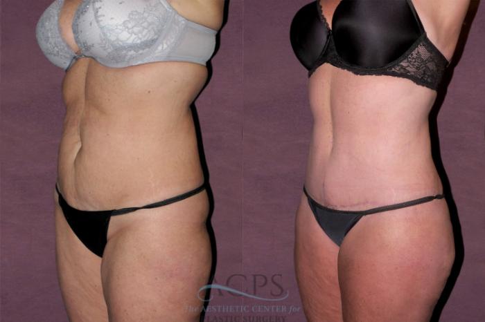 Before & After Tummy Tuck Case 141 Oblique Left View: View in Houston, TX