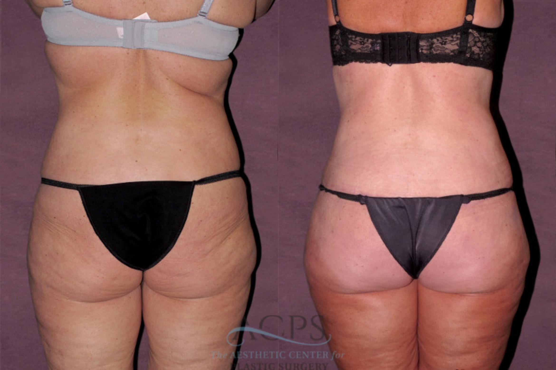 Before & After Tummy Tuck Case 141 Rear View: View in Houston, TX