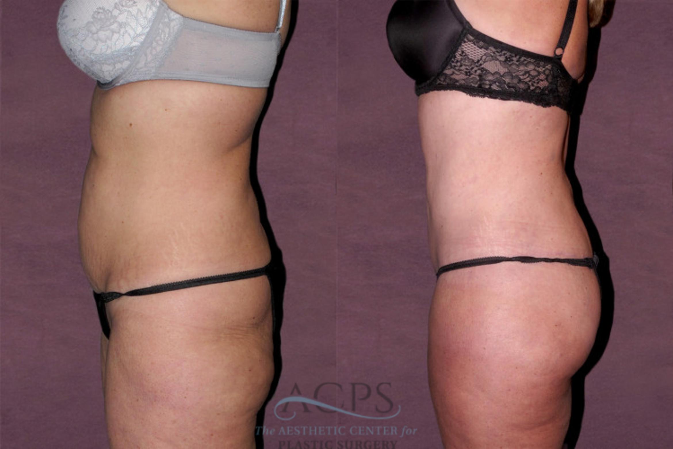 Before & After Tummy Tuck Case 141 Side Left View: View in Houston, TX