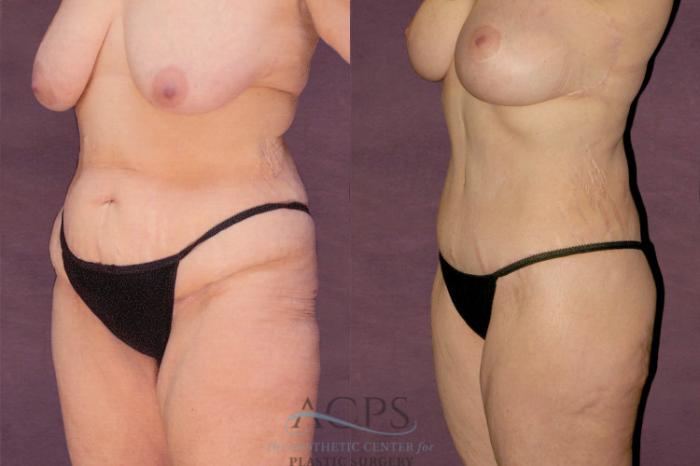Before & After Tummy Tuck Case 142 Oblique Left View: View in Houston, TX