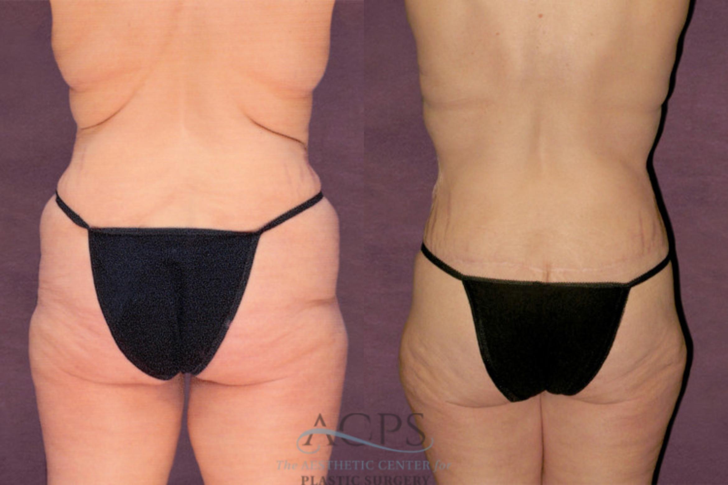 Before & After Tummy Tuck Case 142 Rear View: View in Houston, TX