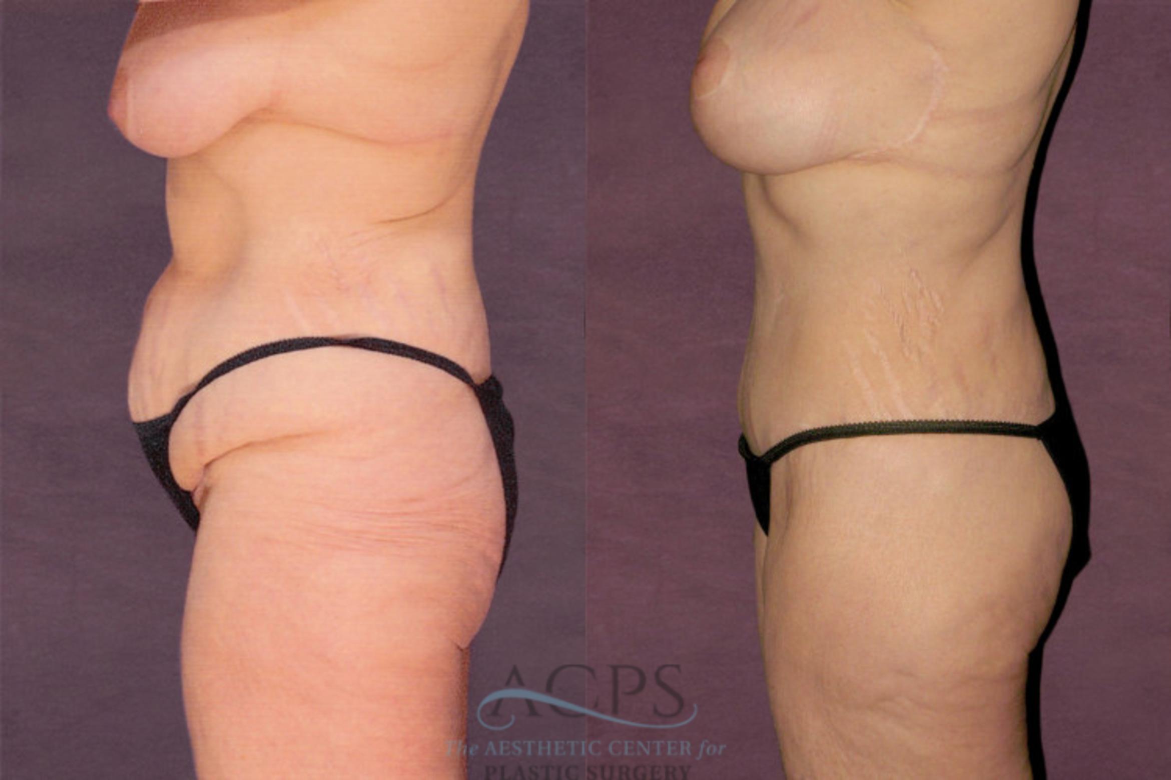 Before & After Tummy Tuck Case 142 Side Left View: View in Houston, TX