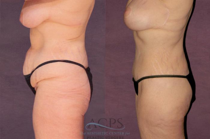 Before & After Tummy Tuck Case 142 Side Left View: View in Houston, TX