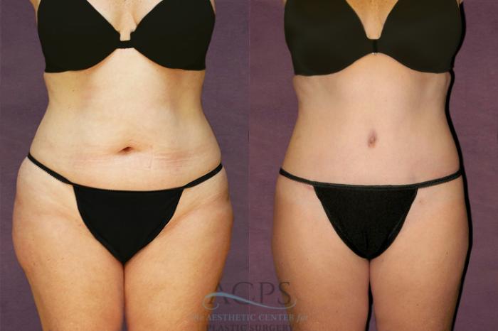 Before & After Tummy Tuck Case 143 Front View: View in Houston, TX