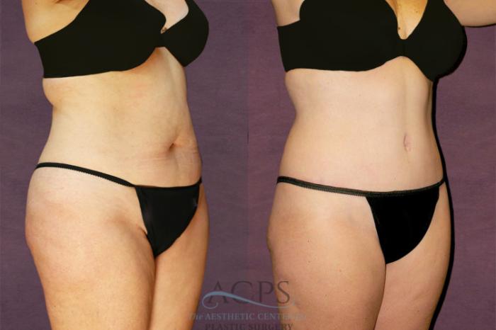 Before & After Tummy Tuck Case 143 Oblique Right View: View in Houston, TX