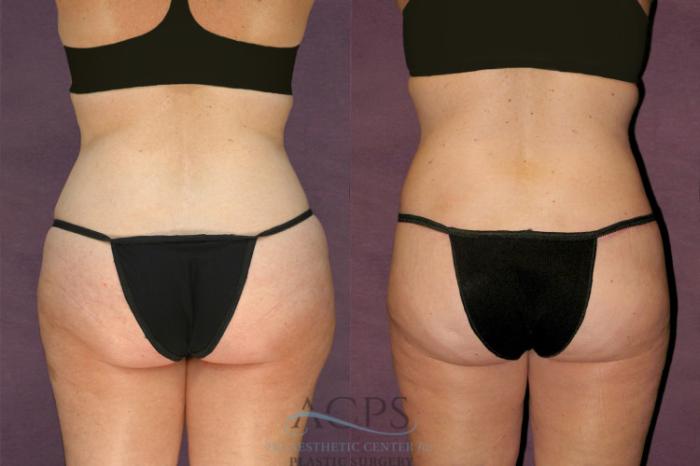 Before & After Tummy Tuck Case 143 Rear View: View in Houston, TX