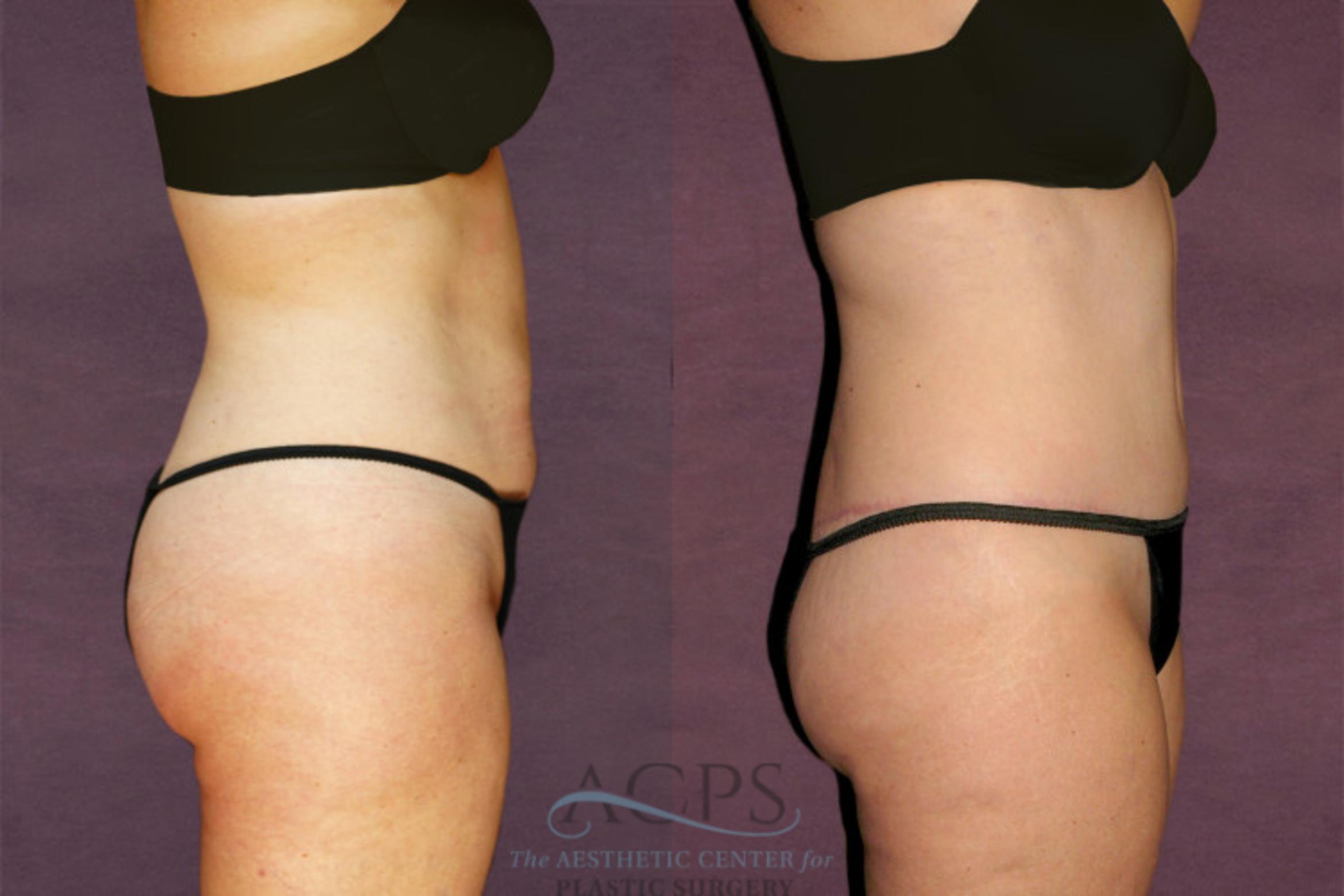 Before & After Tummy Tuck Case 143 Side Right View: View in Houston, TX