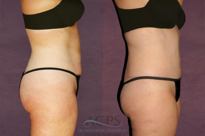 Before & After Tummy Tuck Case 143 Side Right View: View in Houston, TX