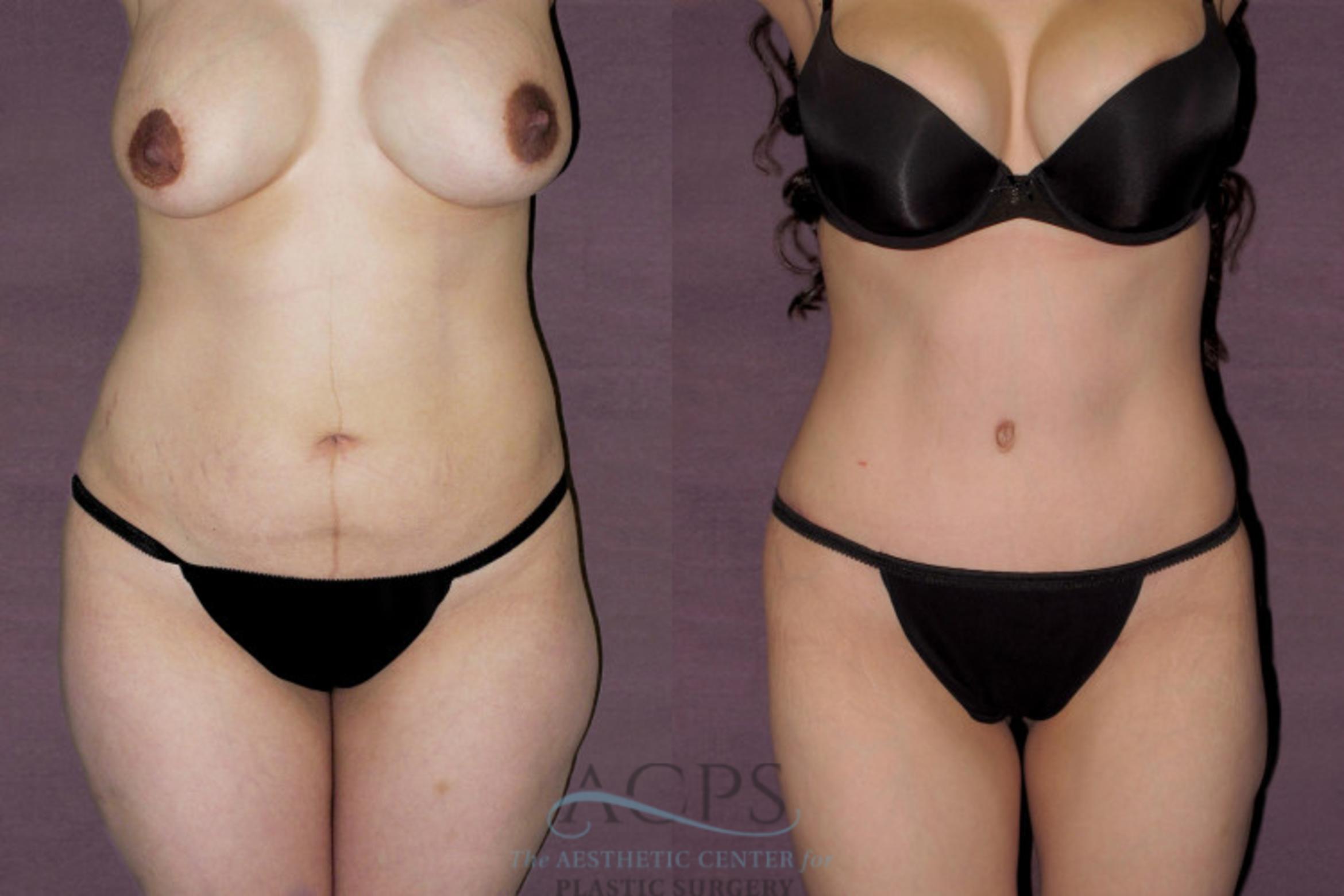 Before & After Tummy Tuck Case 144 Front View: View in Houston, TX
