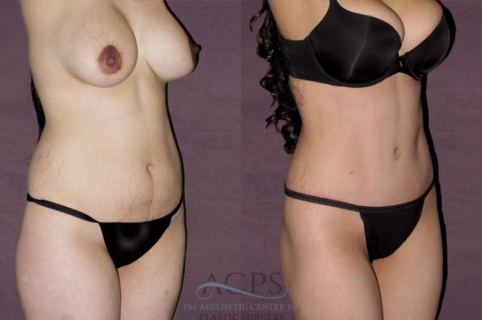 Before & After Tummy Tuck Case 144 Oblique Right View: View in Houston, TX