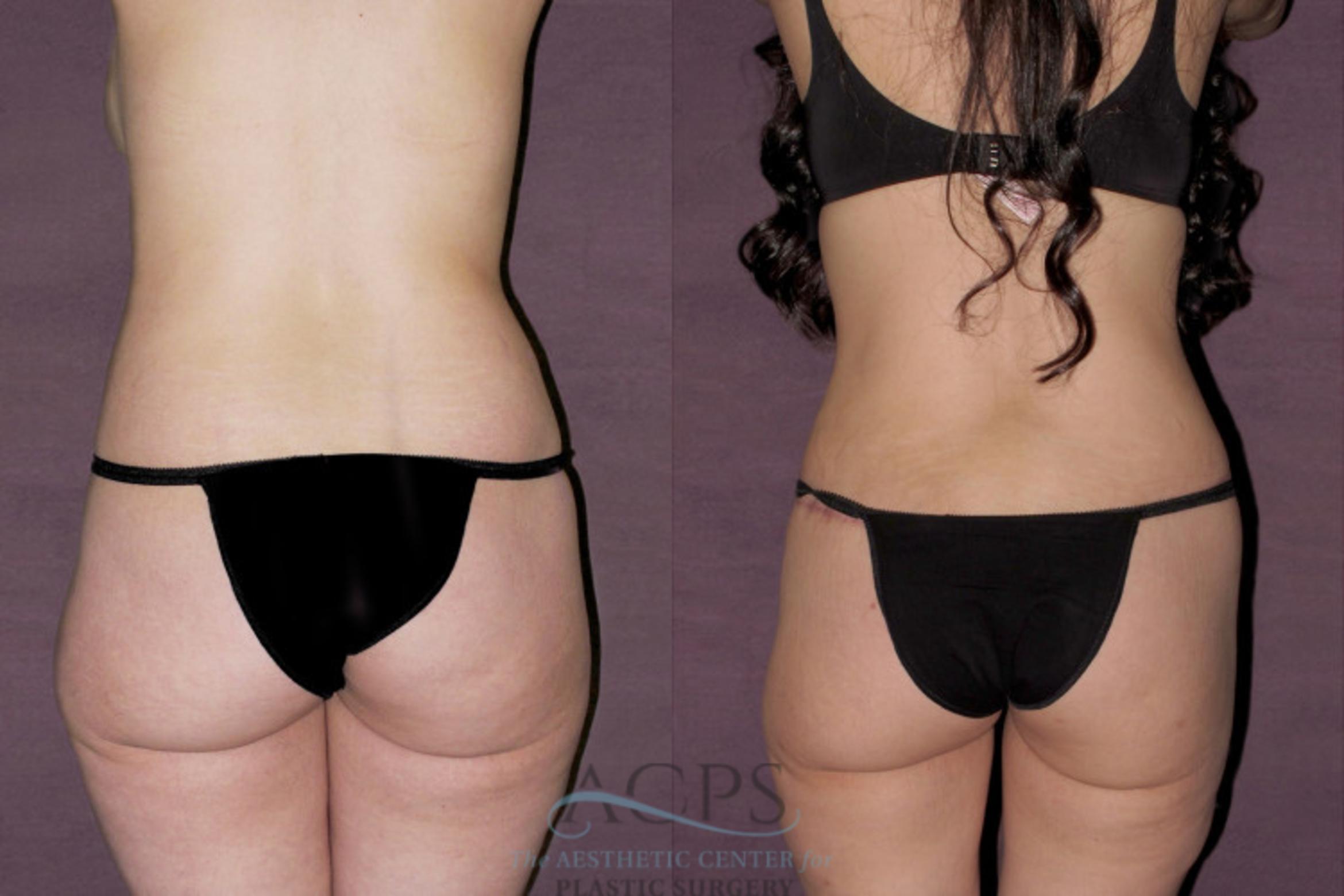 Before & After Tummy Tuck Case 144 Rear View: View in Houston, TX