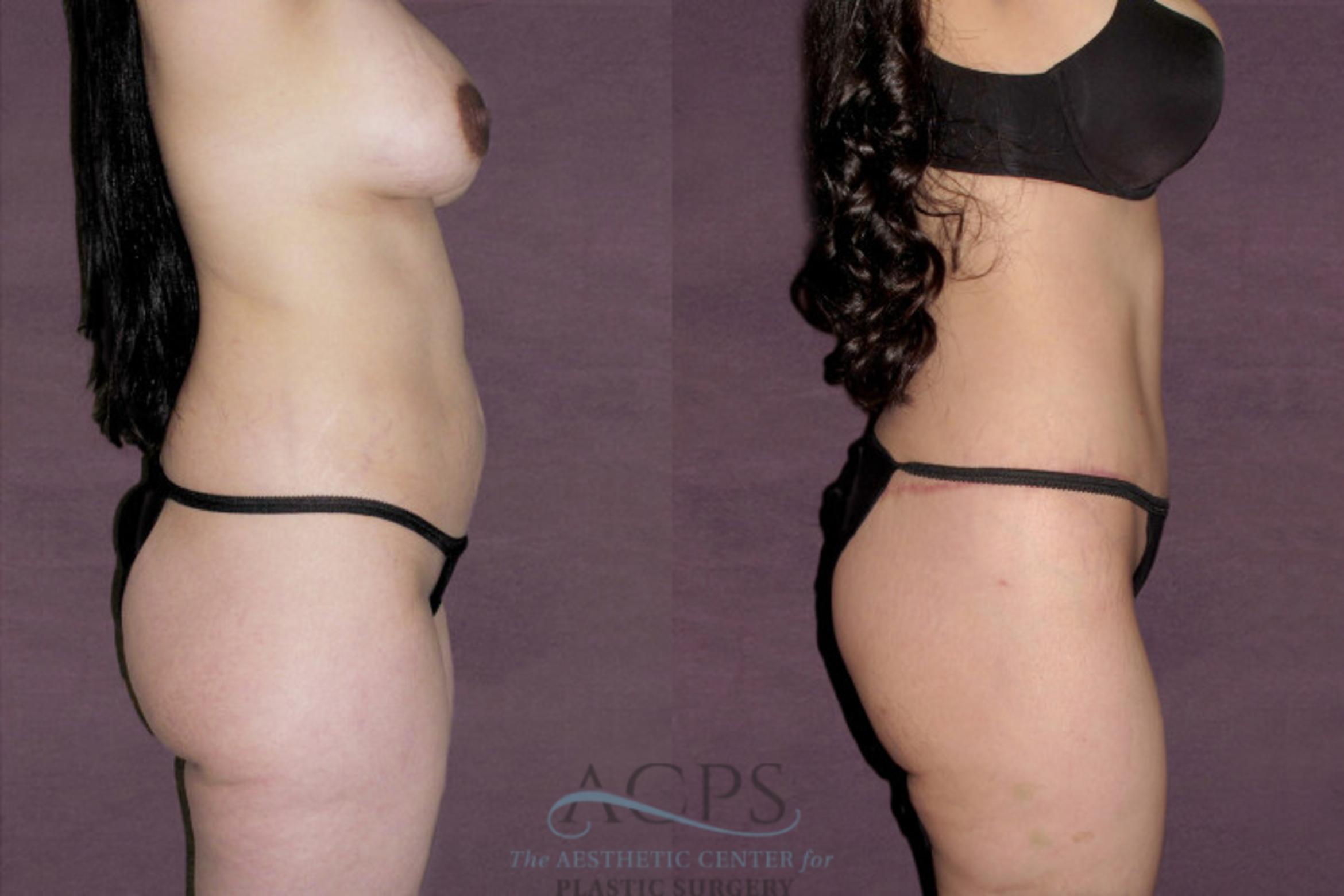 Before & After Tummy Tuck Case 144 Side Right View: View in Houston, TX