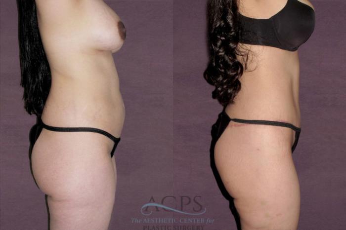 Before & After Tummy Tuck Case 144 Side Right View: View in Houston, TX