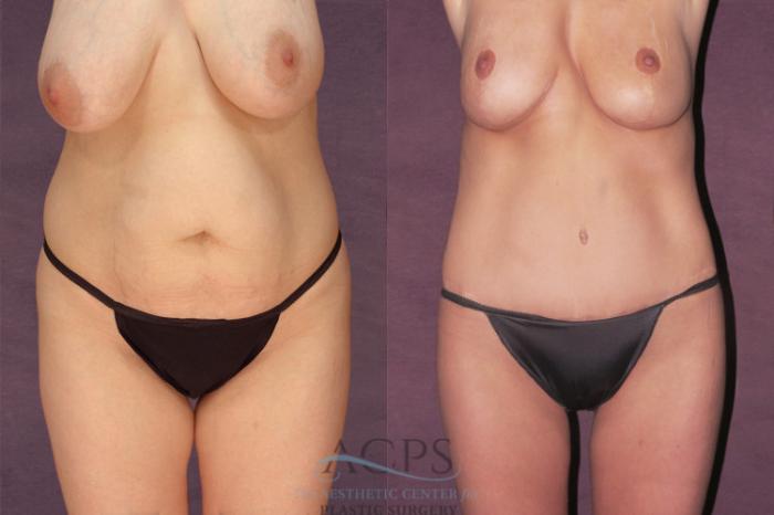 Before & After Tummy Tuck Case 145 Front View: View in Houston, TX
