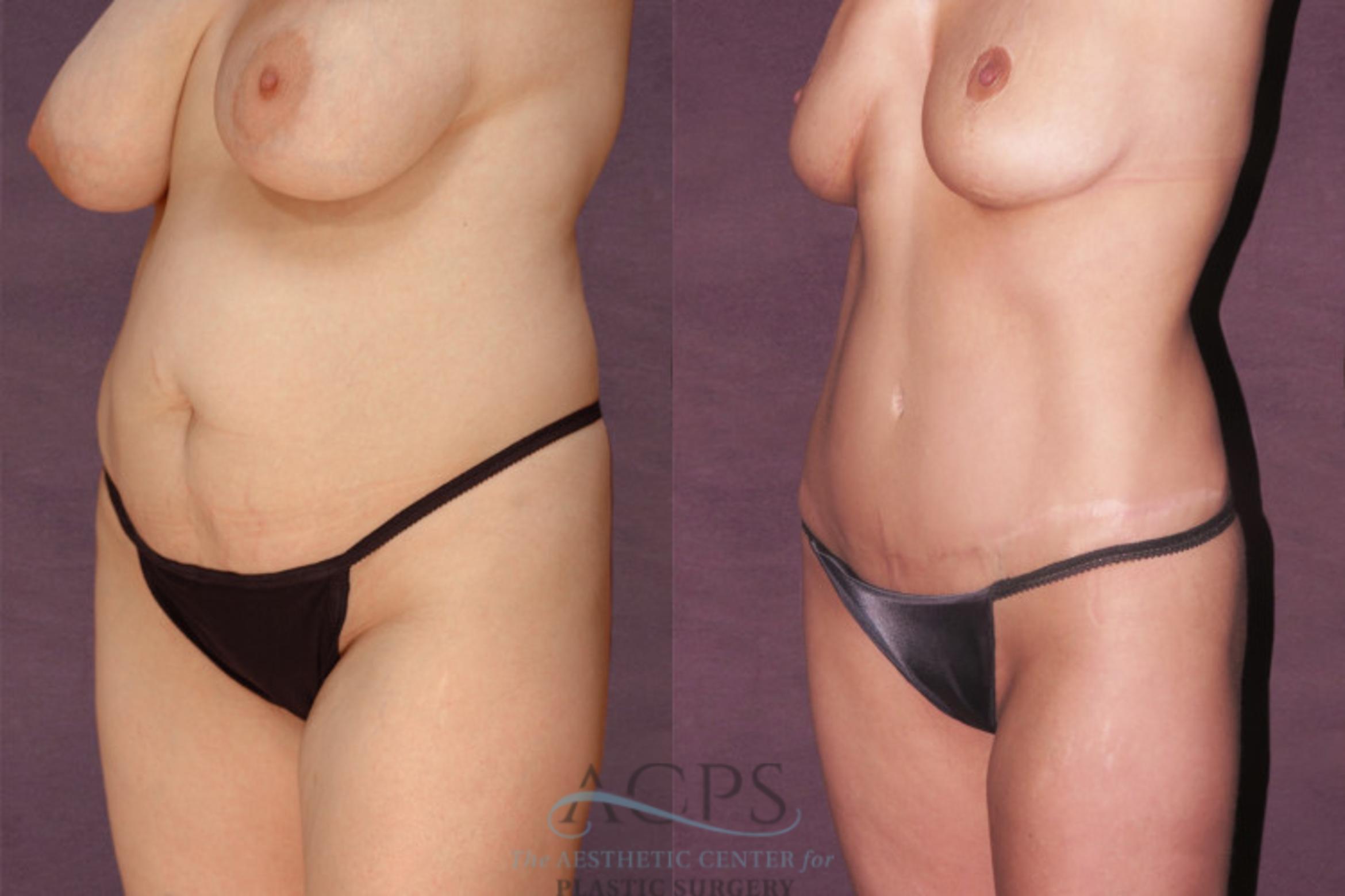Before & After Tummy Tuck Case 145 Oblique Left View: View in Houston, TX