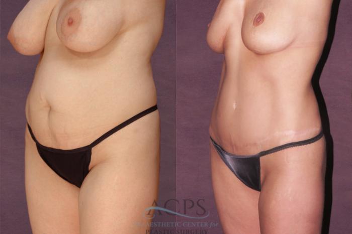 Before & After Tummy Tuck Case 145 Oblique Left View: View in Houston, TX