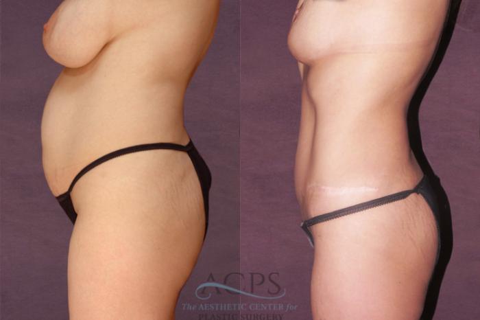 Before & After Tummy Tuck Case 145 Side Left View: View in Houston, TX