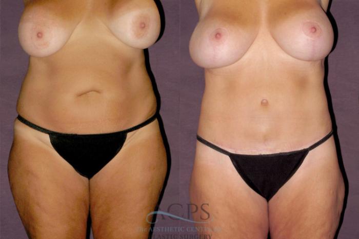 Before & After Tummy Tuck Case 146 Front View: View in Houston, TX