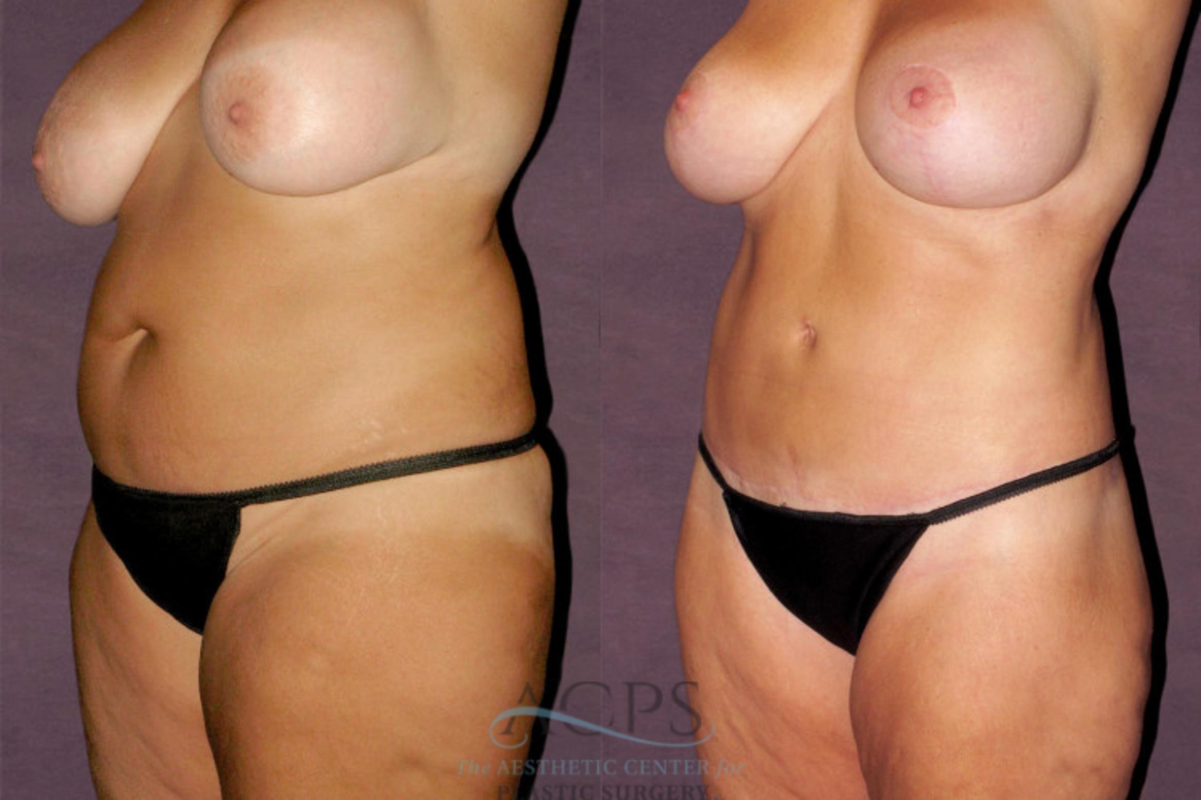Before & After Tummy Tuck Case 146 Oblique Left View: View in Houston, TX